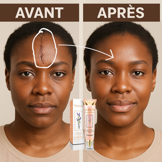 Crème anti-Cicatrices Ultra-Efficace – Élimine Cicatrices, Vergetures & Marques en 21 Jours